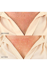 Decollette, Breast & Butt Occlusion Patch