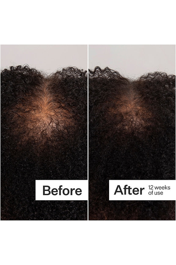 Scalp Dermastamp For Thicker + Fuller Looking Hair