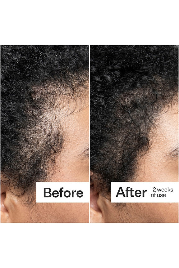 Scalp Dermastamp For Thicker + Fuller Looking Hair
