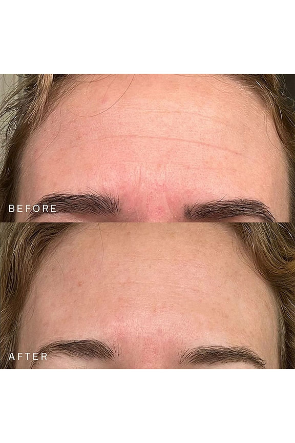 Forehead Occlusion Patch