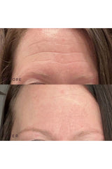 Forehead Occlusion Patch