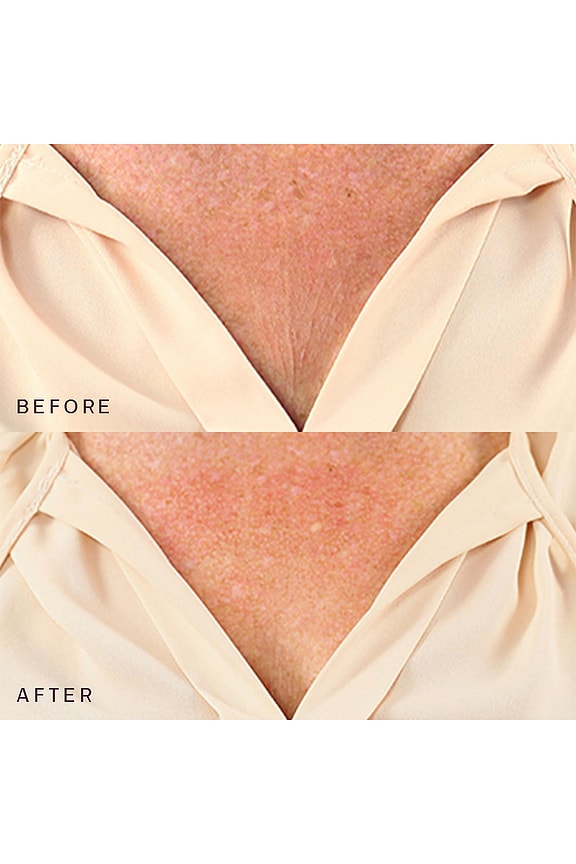 Decollette, Breast &amp; Butt Occlusion Patch