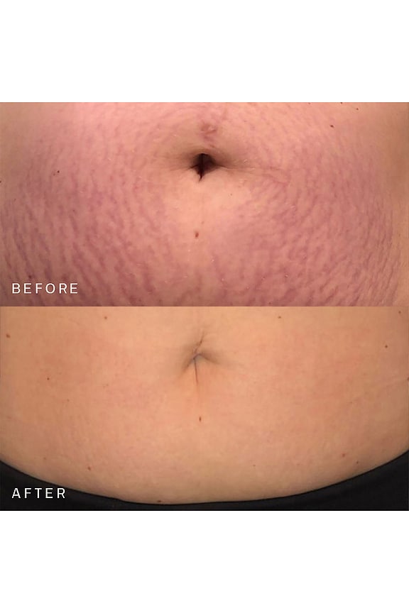 Belly &amp; Body Occlusion Patch
