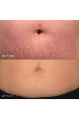 Belly &amp; Body Occlusion Patch