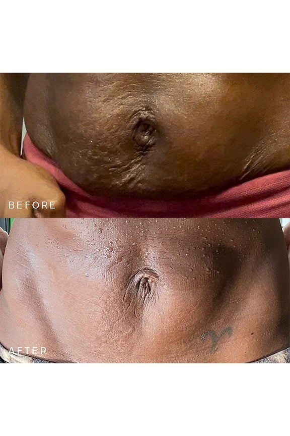 Belly &amp; Body Occlusion Patch