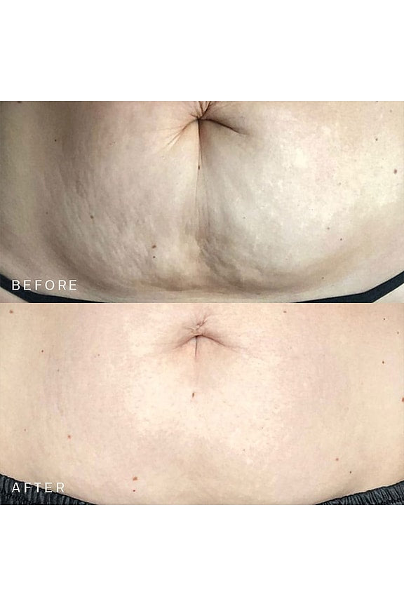Belly &amp; Body Occlusion Patch