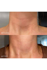 Neck Occlusion Patch