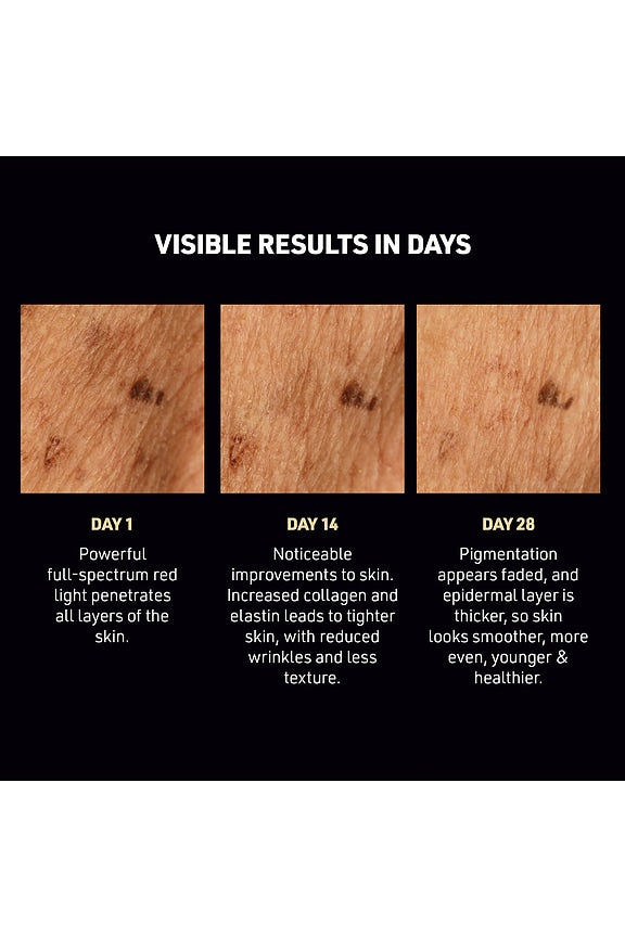 FAQ 502 DPL Photorejuvenation Skin Renewal Device