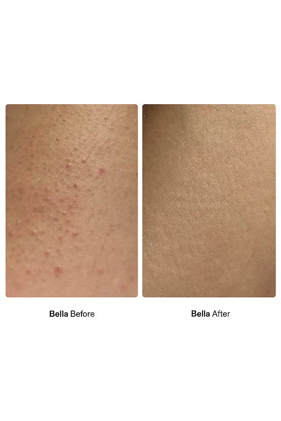 Bump Barrier Oil For Ingrown Hairs