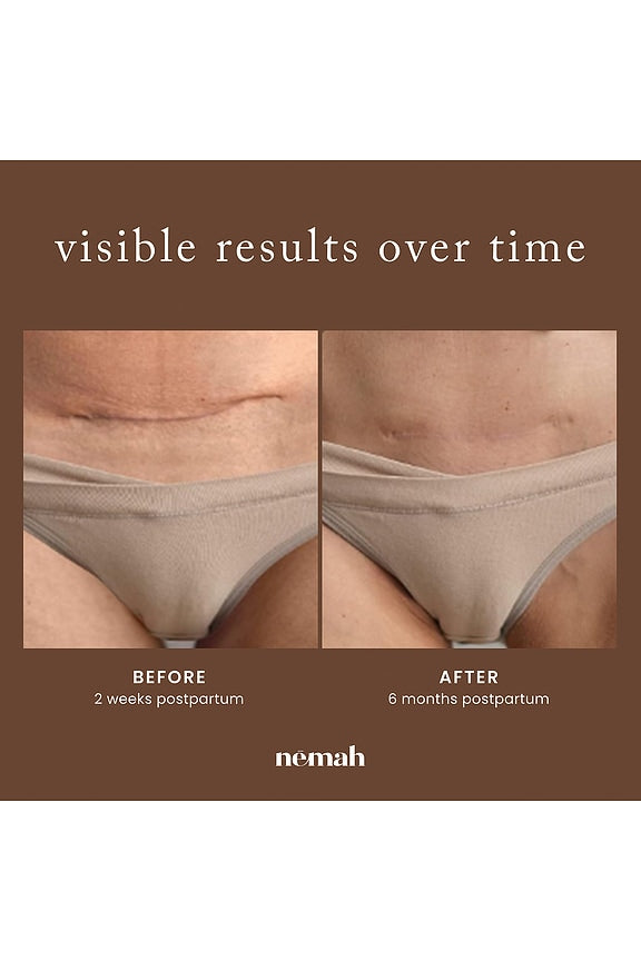 Scar Treatment